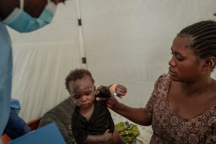 MPOX au Burundi : plus de 60% des moins de 19 ans touchés