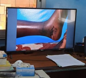 Santé/Dori: un enfant mordu par un serpent soigné à partir de Ouagadougou
