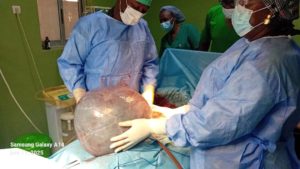 CHR de Tenkodogo : Une patiente opérée avec succès d’un kyste ovarien de 20 kg